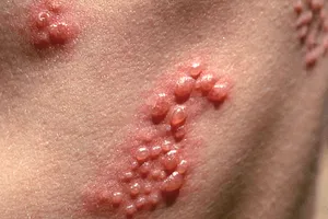 Những điều cần biết về bệnh zona thần kinh