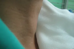 Phát hiện sớm ung thư tuyến giáp