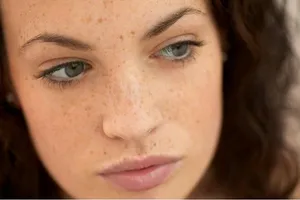 Phân biệt tàn nhang và nốt ruồi