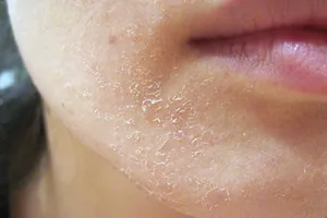 Những điều cần biết về bệnh chàm