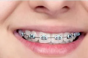 Cách giảm đau buốt sau khi niềng răng