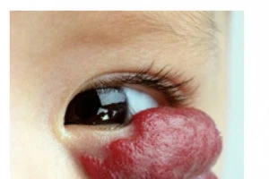 U máu có nguy hiểm đến tính mạng?