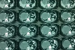 Đến viện khám ho, phát hiện u thận nặng 5 kg