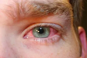 Phòng và chữa bệnh đau mắt đỏ đúng cách