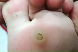 Đừng coi thường mụn cóc lòng bàn chân