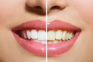 13 nguyên do gây vàng răng mà bạn không thể ngờ