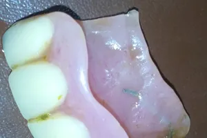 Hy hữu:Tìm thấy răng giả bị mất trong… dạ dày