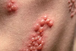 Bệnh giời leo có phải là bệnh zona thần kinh?