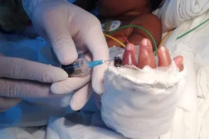 Bé 2 tuổi theo mẹ đi làm bị xích máy cắt gạch cắt lìa bàn tay