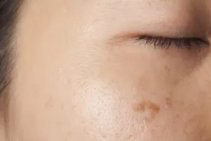 Những thành phần tự nhiên có khả năng chữa trị thâm nám