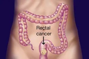 Những nguyên nhân gây ung thư trực tràng 