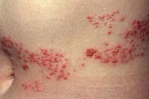 Lựa chọn các thuốc điều trị đau thần kinh sau zona