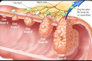 Dấu hiệu vàng cảnh báo sớm bệnh ung thư đại trực tràng