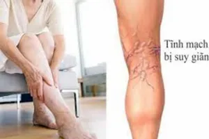 Tăng huyết áp có dùng thuốc giãn tĩnh mạch được không?