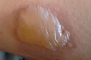 Chữa bỏng bô xe máy đúng cách