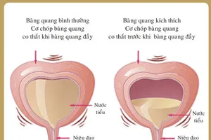 Đi tiểu nhiều, có phải bệnh lý?