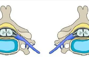 Dấu hiệu thoát vị đĩa đệm cột sống cổ