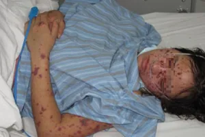 Bệnh nhân mắc viêm não mô cầu có thể tử vong sau 1 ngày