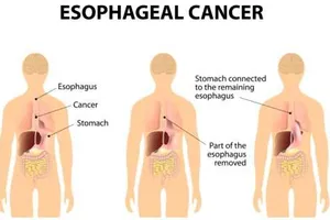 Bệnh nướu răng có thể dẫn đến ung thư thực quản