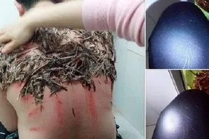 Thực hư việc trị bệnh đậu lào bằng lông và máu gà