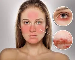 Thường xuyên đỏ mặt là triệu chứng bệnh mất trí nhớ?