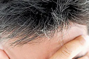 Infographic: 8 bài thuốc đơn giản chữa tóc bạc sớm