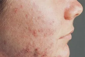 Cách xử lý khi bị viêm da cơ địa