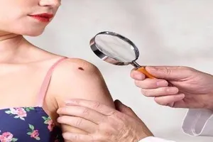 5 nguy cơ không ngờ gây ung thư da