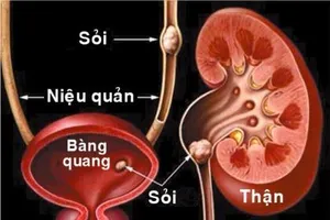Infographic: Những bài thuốc dân gian trị sỏi thận hiệu quả