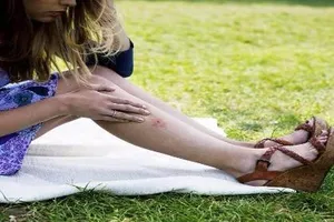 5 vết côn trùng cắn bạn không nên chủ quan