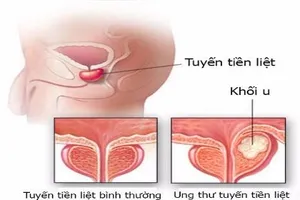 10 căn bệnh ung thư có nguy cơ cao với nam giới