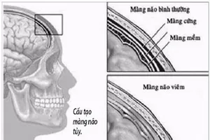 Lao màng não, thể lao nguy hiểm
