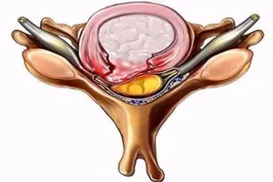 Thoát vị đĩa đệm và những hậu quả khó lường