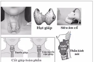 Ai dễ bị ung thư tuyến giáp?