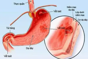 Infographic: 8 món ăn người bị viêm dạ dày cần tránh xa