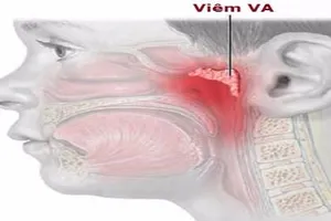 Những điều cần biết về viêm VA
