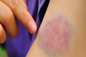 Vì sao vết thương gây bầm tím kéo dài?