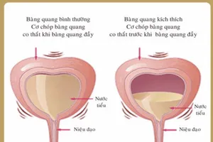 Đi tiểu nhiều - bệnh gì?