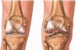 Thấp khớp cấp, thấp tim: Dùng thuốc gì, vào lúc nào?