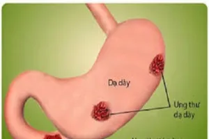Cách phát hiện sớm ung thư đường tiêu hóa