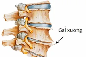Gai cột sống và những quan niệm sai lầm trong điều trị