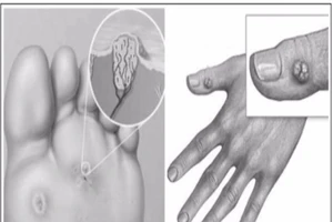 Mụn cóc và thuốc trị