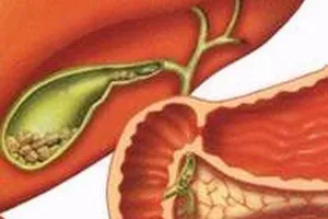 Sỏi túi mật: Bệnh thầm lặng mà nguy hiểm