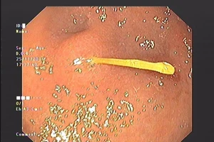 Suýt thủng dạ dày vì nuốt tăm khi uống nước