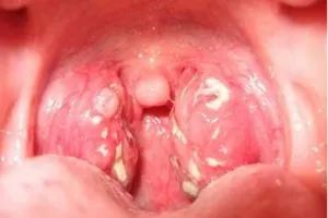 Viêm họng hạt nguy hiểm như thế nào?