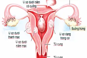 Nhân xơ tử cung khi nào thì phẫu thuật?
