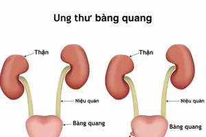 Ung thư bàng quang