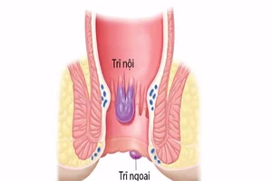 Nhận biết bệnh trĩ