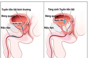 Nguyên nhân và cách phòng tránh phì đại tiền liệt tuyến