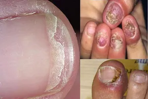 Cần kiên trì khi trị nấm móng